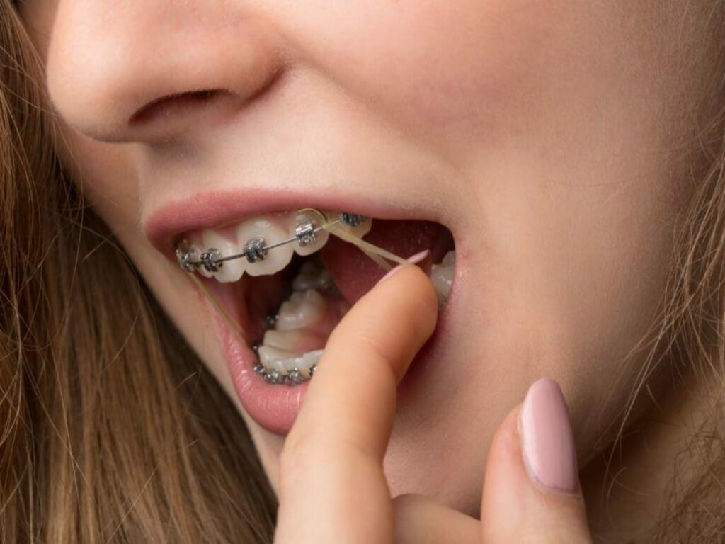 Élastiques Intermaxillaires